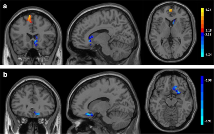 Sex-specific effects of cigarette smoking on caudate and amygdala volume  and resting-state functional connectivity | Brain Imaging and Behavior