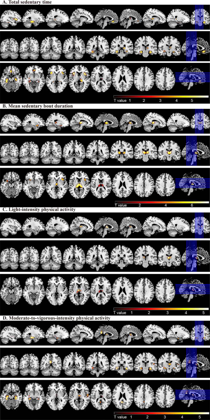 Characterizing Gray matter atrophy patterns associated with ...