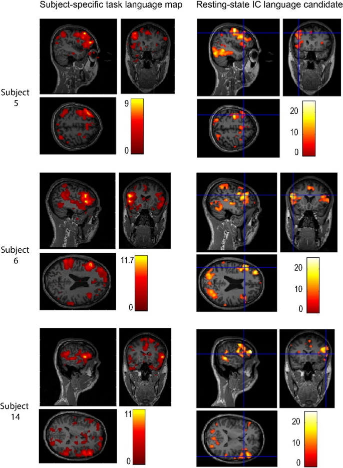 Improving presurgical language mapping by a method for optimally ...