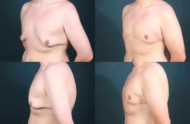 Post Bariatric Male Chest Re-shaping Using L-Shaped Excision Technique