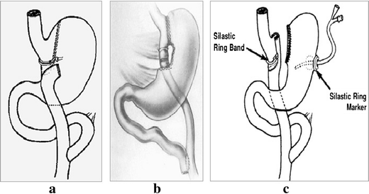 Systematic Review and Meta-analysis of Medium-Term Outcomes After Banded  Roux-en-Y Gastric Bypass | SpringerLink