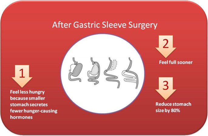Changes In Gut Microbiota And Hormones After Bariatric Surgery A Bench To Bedside Review Springerlink