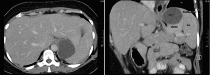 Laparoscopic Sleeve Gastrectomy for Oesophago-gastric Junction 