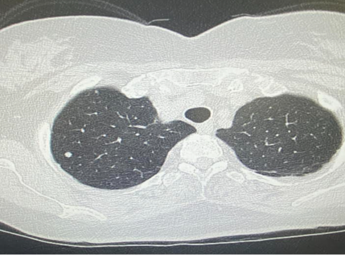 Mourning  Bronchoscopy International