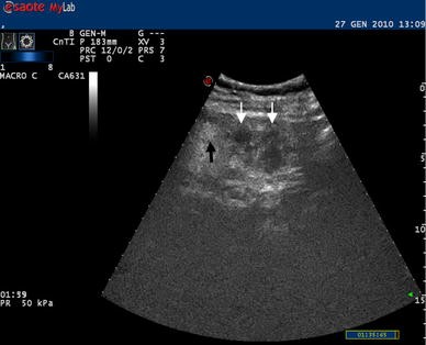 A Rare Cause Of Left Upper Quadrant Abdominal Pain Springerlink