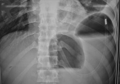 Acute Gastric Volvulus Springerlink Acute Gastric Volvulus Springerlink