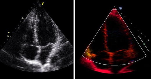A Clinician's Guide to Tissue Doppler Imaging