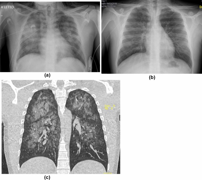 smoking cigarettes with pneumonia Smoke on the water”: a challenging case of pneumonia | Internal and  Emergency Medicine