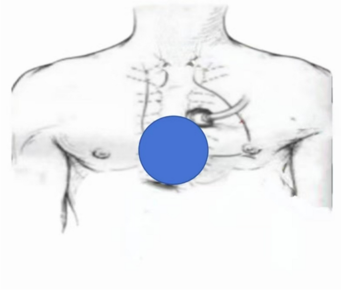 Chest Spring Positive Impact of bedside ultrasound-informed cardiopulmonary resuscitation on ...