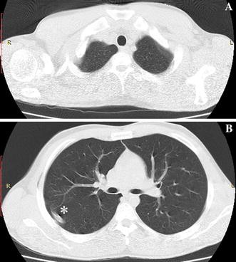 Pulmonary Talc Granulomatosis in a Cocaine Sniffer - ScienceDirect