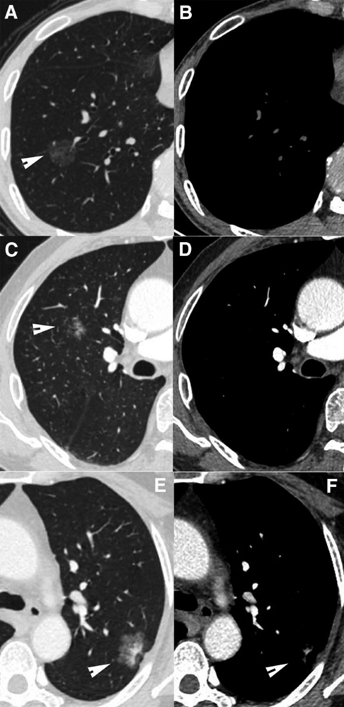 The diagnosis and treatment of lung cancer presented as ground-glass nodule  | SpringerLink