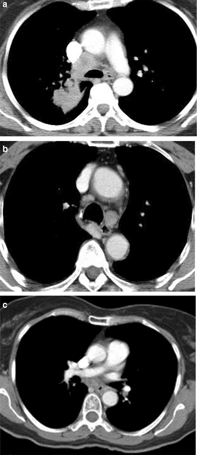 Lymph Node Assessment In Early Stage Non Small Cell Lung Cancer Lymph Node Dissection Or Sampling Springerlink