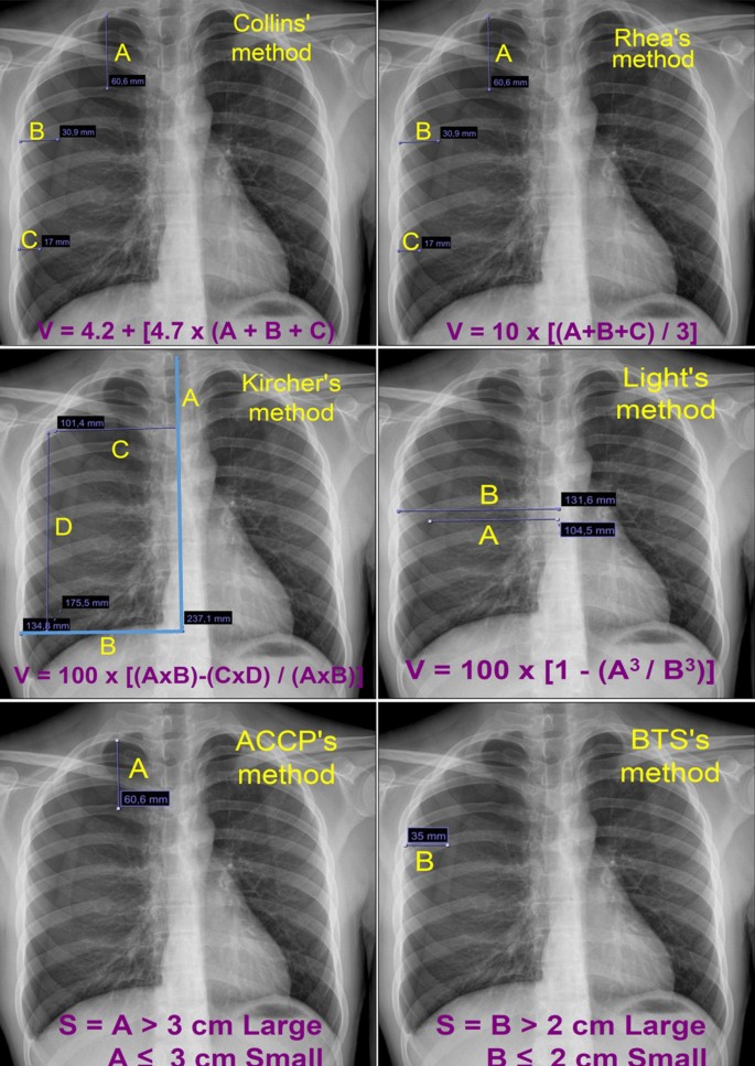 Which pneumothorax volume/size measurement method can best predict surgical  indication in primary spontaneous pneumothorax patients? A comparison of  six different methods | SpringerLink