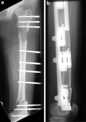 Femoral lengthening with a rail external fixator: tips and tricks |  SpringerLink
