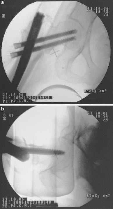 Dual lag screw cephalomedullary nail versus the classic sliding hip screw  for the stabilization of intertrochanteric fractures. A prospective  randomized study | SpringerLink