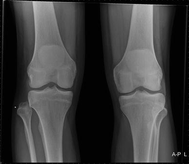 Proximal tibiofibular dislocation: a case report and review of literature |  SpringerLink