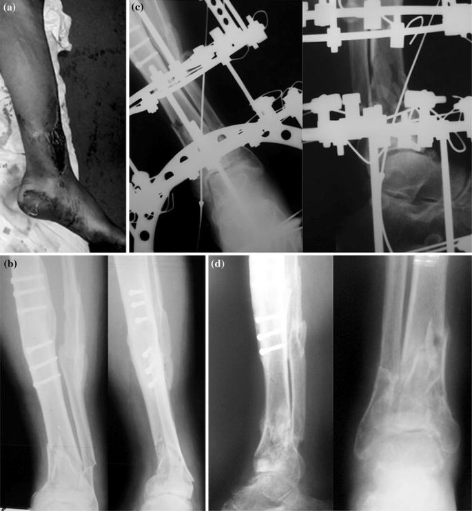 Full ring external fixation (Ilizarov) for Extraarticular, wedge fracture