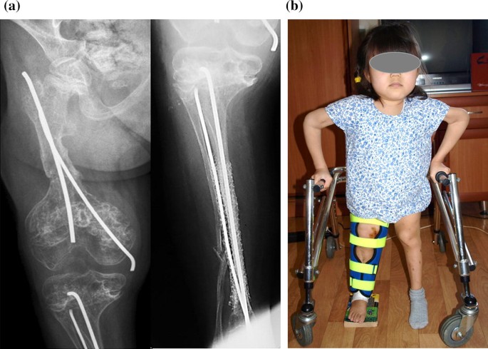 Get married cat forget Use of flexible intramedullary nailing in combination with an external  fixator for a postoperative defect and pseudarthrosis of femur in a girl  with osteogenesis imperfecta type VIII: a case report | SpringerLink