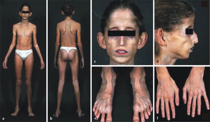 Progeroide Variante Eines Marfan Syndroms Springerlink