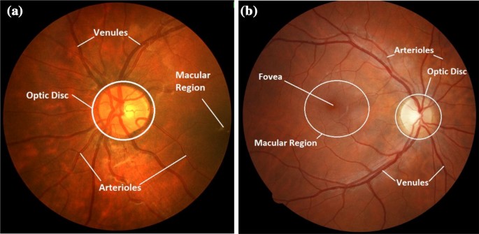 retinal edema