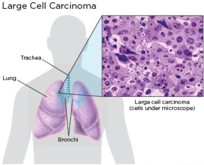 Early Detection of Lung Cancer Using Deep Learning Techniques: A ...