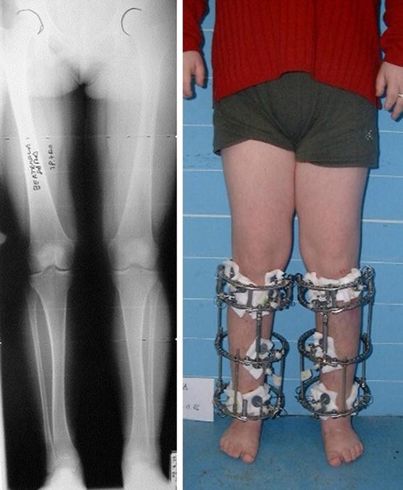 Full-ring Ilizarov frame applied for lengthening of tibia.