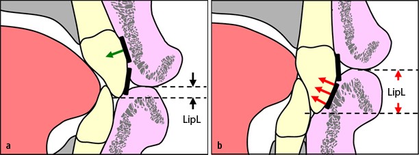 mittlerer oberer Alveolar