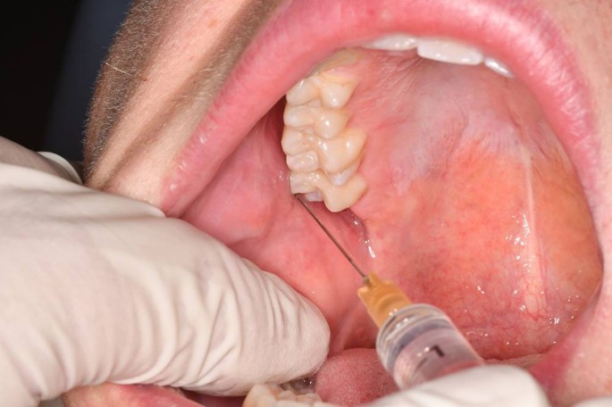 Die zahnärztliche Leitungsanästhesie – technische und anatomische  Variationen als mögliche Ursachen für einen Misserfolg | SpringerLink