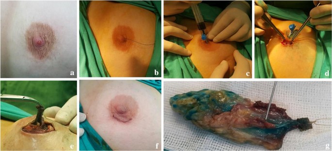 intraductal papilloma removal)