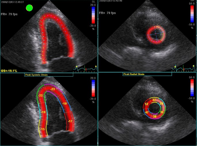 a Myocardial strain imaging by speckle tracking echocardiography of a