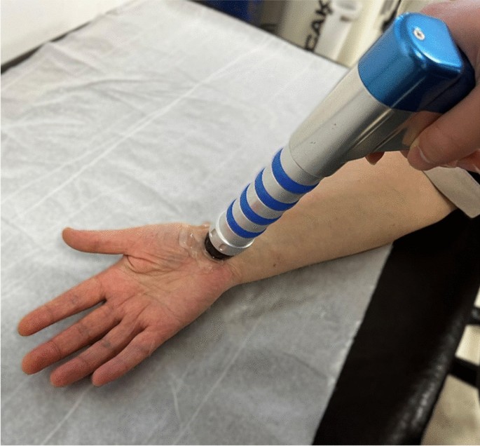 Effects of radial extracorporeal shock wave and kinesio taping on pain ...
