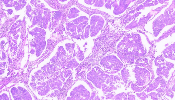 IHC analysis of estrogen receptor (ER) and progesterone receptor (PR ...