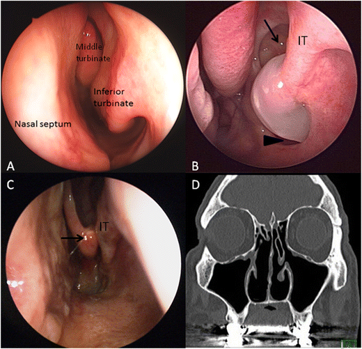 Empty Nose Syndrome Springerlink Empty Nose Syndrome Springerlink