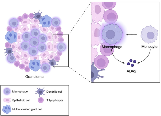 A Review of Adenosine Deaminase 2 (ADA2) as a Biomarker of Monocyte ...