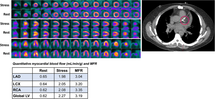 Left Ventricular Strain from Myocardial Perfusion PET Imaging