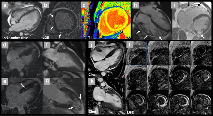 Cardiovascular Magnetic Resonance Imaging and Heart Failure | SpringerLink