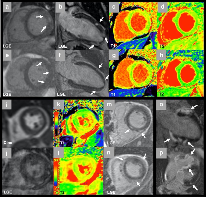 Patterns of CMR measured longitudinal strain and its association with late  gadolinium enhancement in patients with cardiac amyloidosis and its mimics, Journal of Cardiovascular Magnetic Resonance