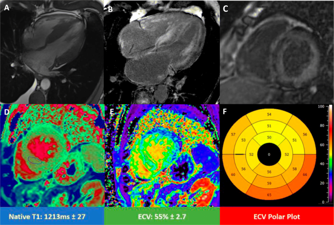 Nuclear and Multimodality Imaging: Cardiac Amyloidosis - CardioNerds