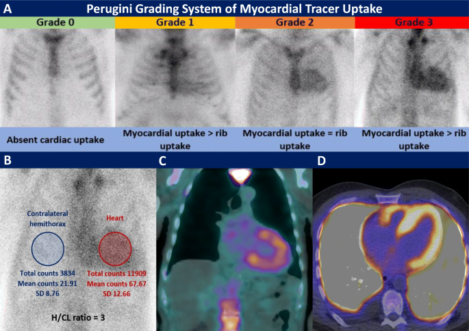 Nuclear and Multimodality Imaging: Cardiac Amyloidosis - CardioNerds