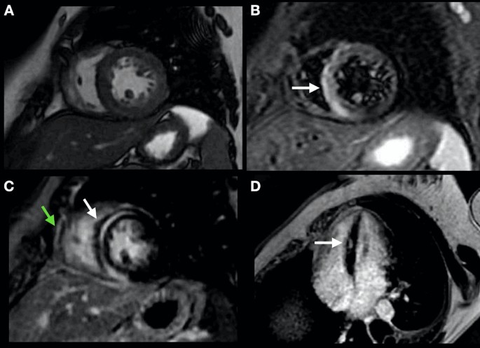 Established and Emerging Techniques for Pericardial Imaging with Cardiac  Magnetic Resonance | SpringerLink
