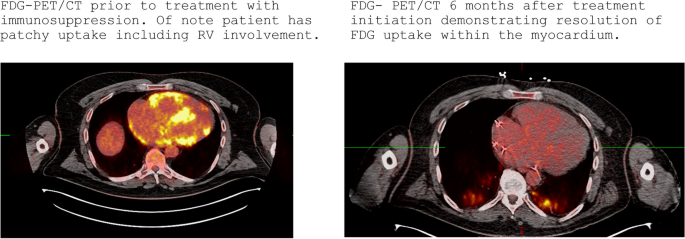 Cardiac Sarcoidosis: Utilizing Cardiac MRI and PET-CT | Current ...