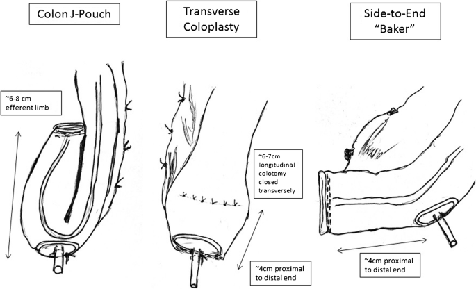 Techniques For Colorectal Anastomotic Construction Following Proctectomy And Variables Influencing Anastomotic Leak Springerlink