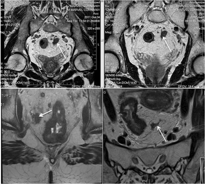 cancer colon mri