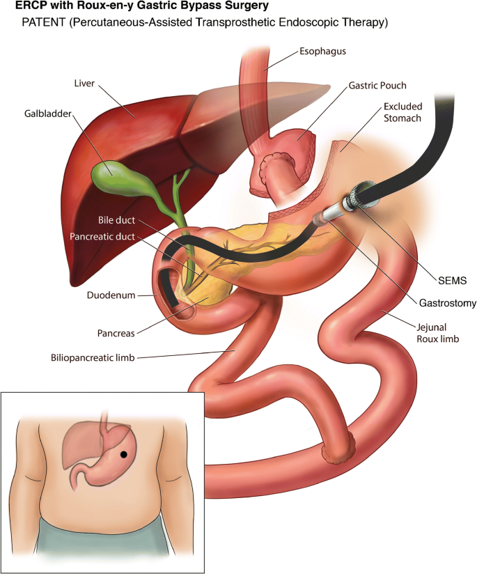 Review of ERCP Techniques in Roux-en-Y Gastric Bypass Patients: Highlight  on the Novel EUS-Directed Transgastric ERCP (EGDE) Technique | SpringerLink