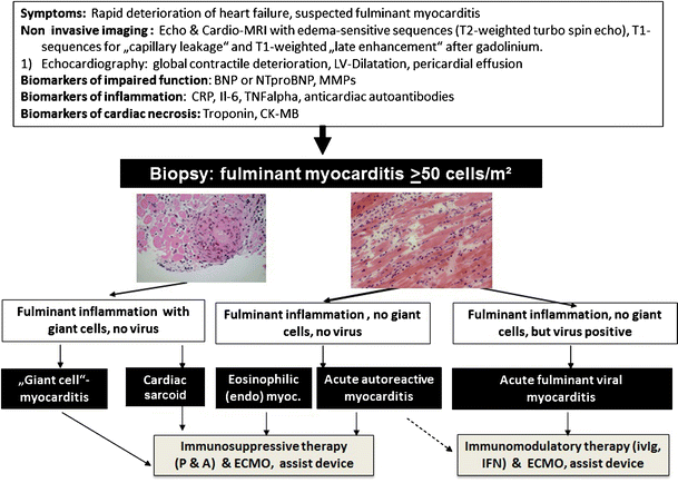 Management Of Fulminant Myocarditis A Diagnosis In Search Of Its Etiology But With Therapeutic Options Springerlink