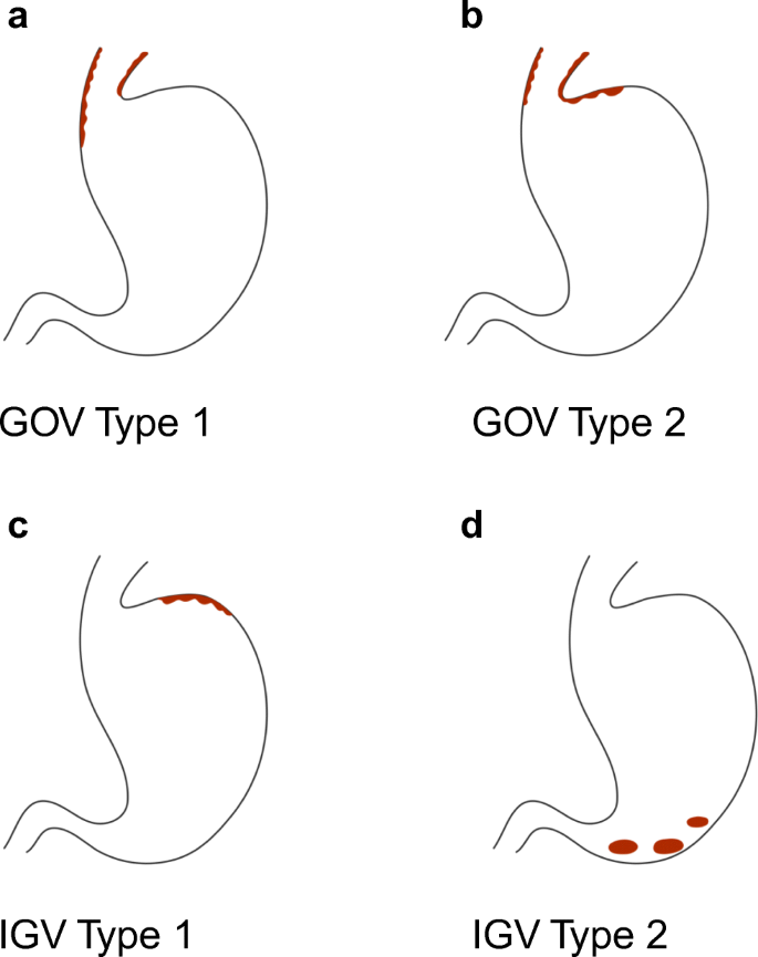Esophageal Varices Primary Prophylaxis And Prevention And Management Of Rebleeding Springerlink Esophageal Varices Primary Prophylaxis And Prevention And Management Of Rebleeding Springerlink
