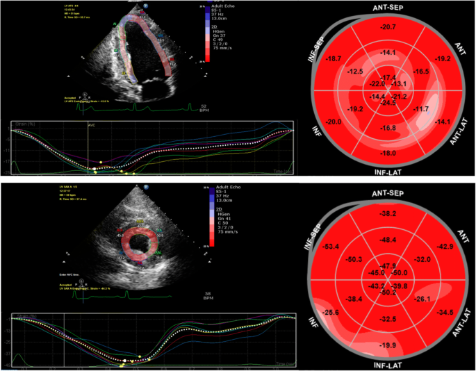 Impaired left ventricular global longitudinal strain is associated with  elevated left ventricular filling pressure after myocardial infarction