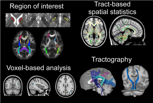 The Evolving Role Of Diffusion Magnetic Resonance Imaging In Movement Disorders Springerlink