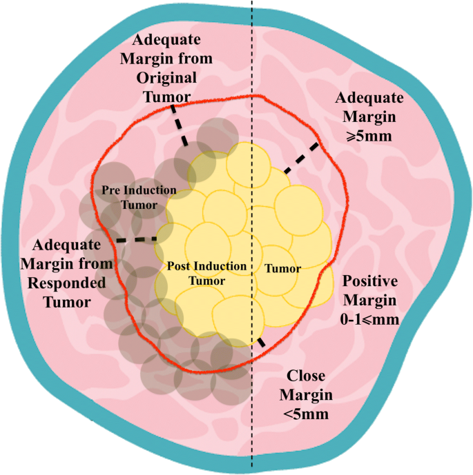 An Update On Surgical Margins In The Head Neck Squamous Cell Carcinoma Assessment Clinical Outcome And Future Directions Springerlink An Update On Surgical Margins In The Head Neck Squamous Cell Carcinoma Assessment Clinical Outcome And Future Directions Springerlink