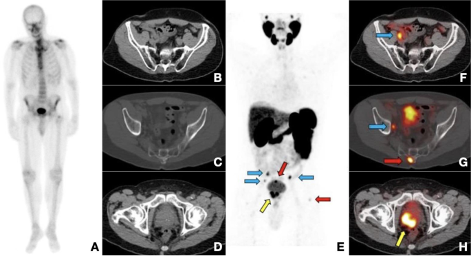 18F-fluciclovine-PET/CT imaging versus conventional imaging alone to guide  postprostatectomy salvage radiotherapy for prostate cancer (EMPIRE-1): a  single centre, open-label, phase 2/3 randomised controlled trial - The  Lancet